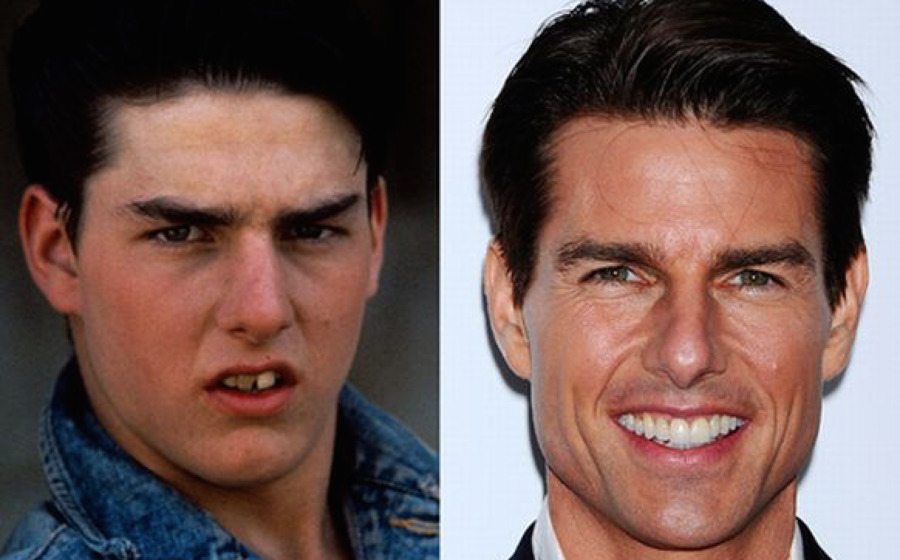 Tom Cruise Denti Celebrità Odontoiatria Impiallacciatura - impatto vol
