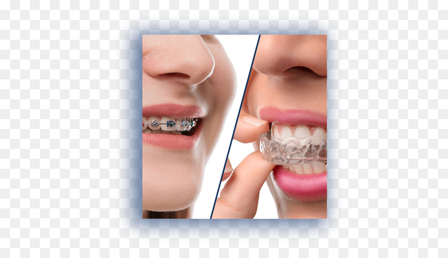 Allineatori trasparenti Ortodonzia Dentale parentesi graffe Odontoiatria - Ortodontista