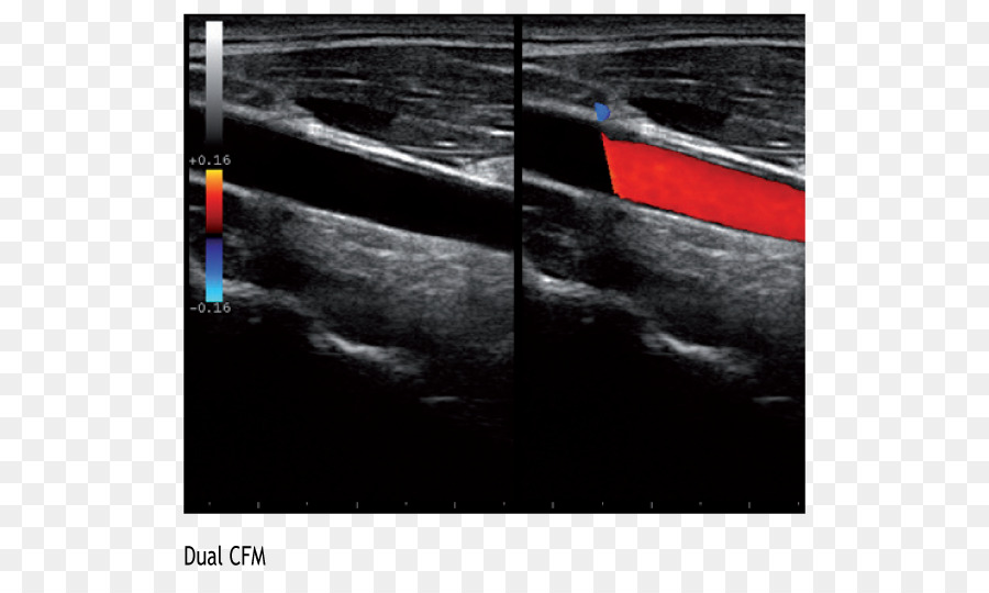 Sonographie Gemeinsame Halsschlagader-Ultraschall-Herz-Kreislauf-Erkrankungen Kardiologie - fortschrittliche Technologie