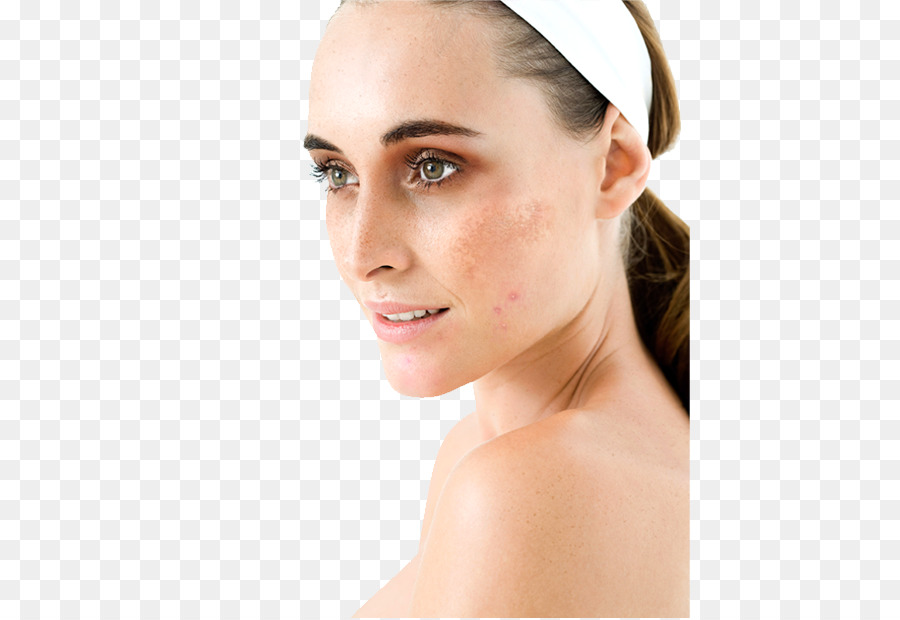Hyperpigmentierung Gesicht Melasma-Therapie, Menschliche Haut Farbe - Gesicht