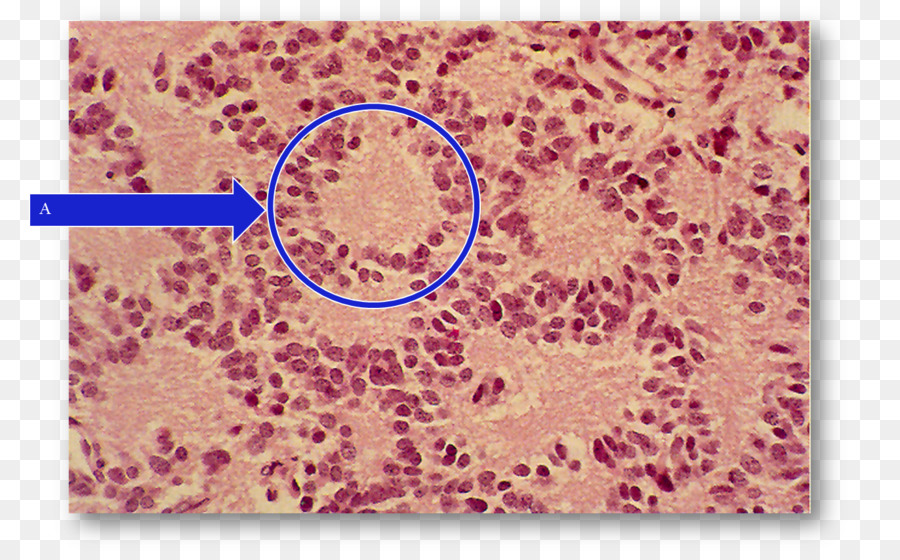 Pineocytoma Pinealoblastoma carta da gioco Anomalia Pollice - pineale