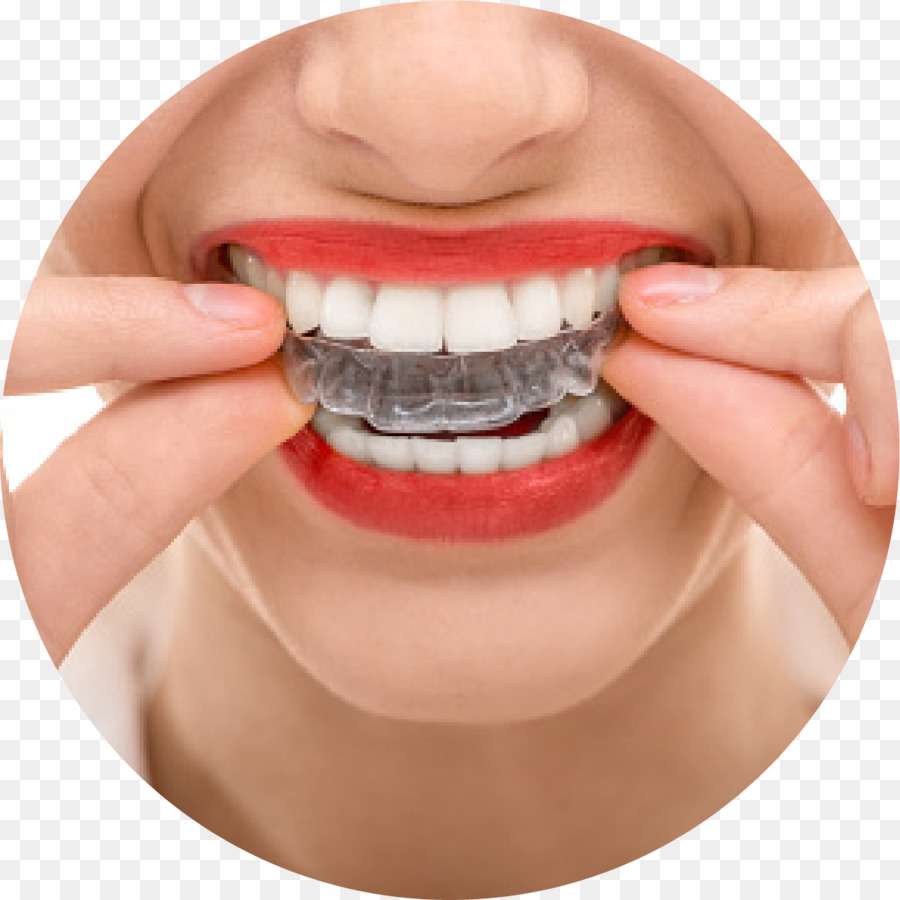 Kieferorthopädie Zahnmedizin, Zahnspangen, Clear-Aligner - verfallenen zahn