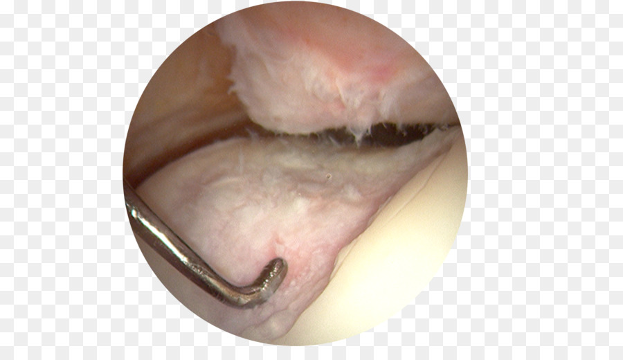 L'artrite del ginocchio Artroscopia Artrosi Superselettiva - cartilagine