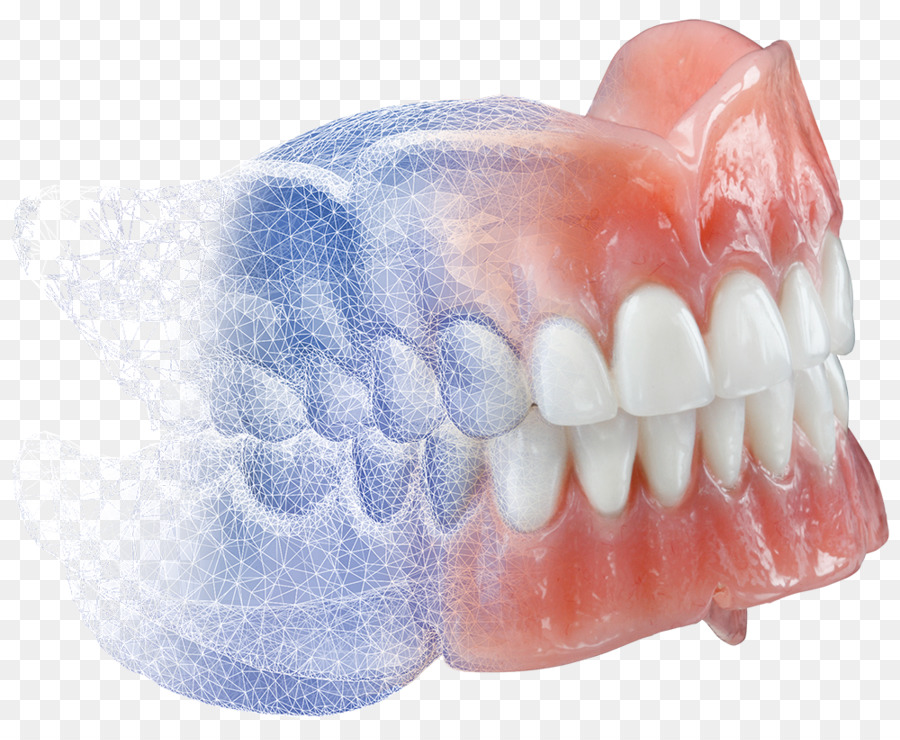Protesi Burdette Laboratorio odontotecnico odontoiatria CAD/CAM - 3d dentale, trattamento per il mal di denti