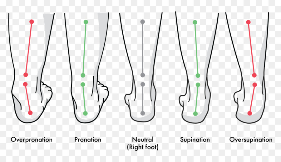 Pronation des Fußes Supination Gang Achilles Sehnenentzündung - andere