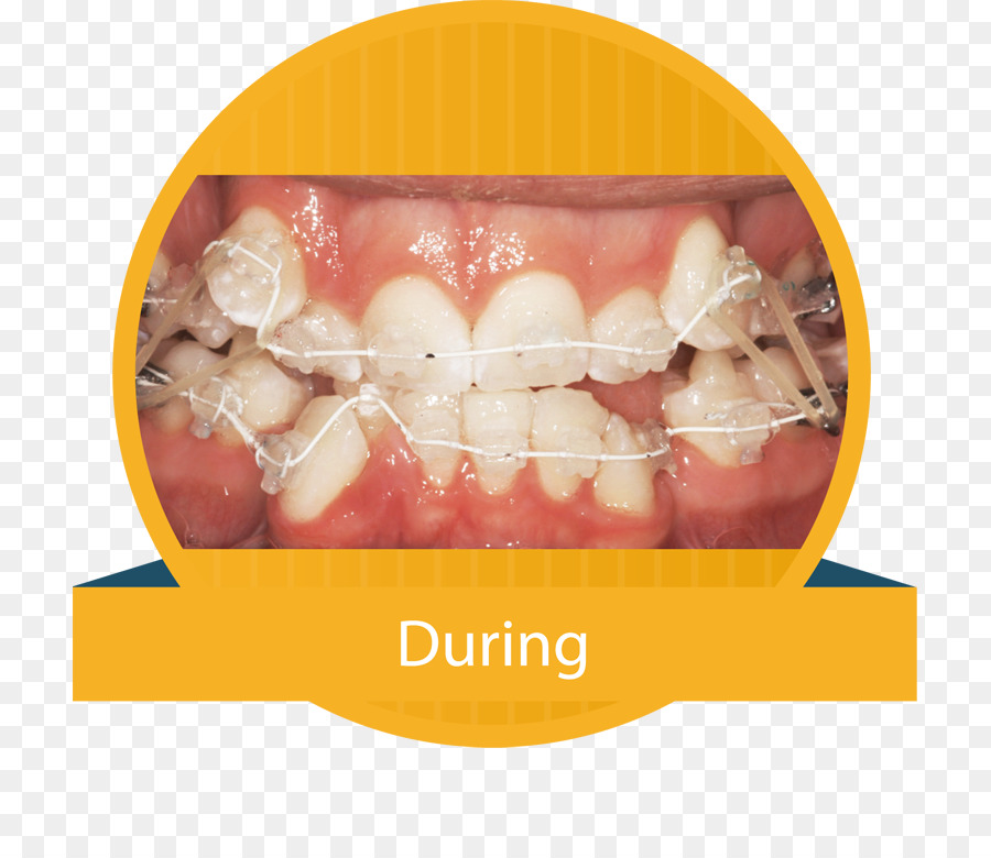 Dente Sorriso Dentale parentesi graffe Testo Medico - denti modello