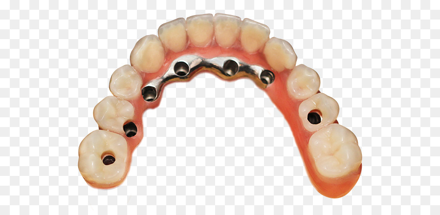 Zahn Zahnersatz Krone, Brücke, Implantologie - Prozess
