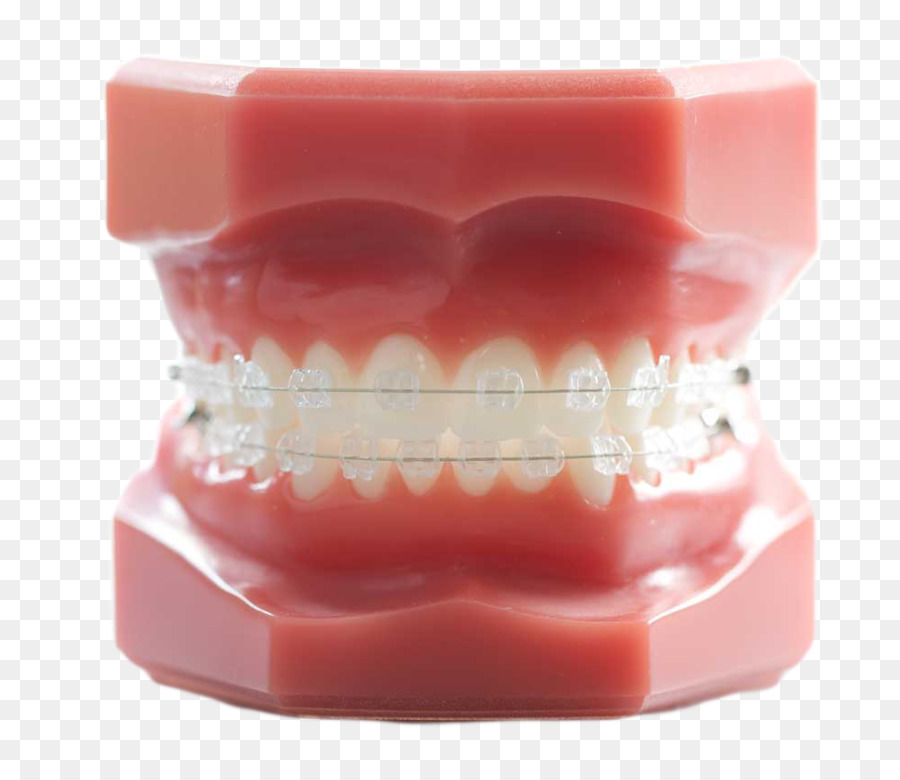 Zahn, Orthodontie, Zahnmedizin, Zahnspangen - dental Modell