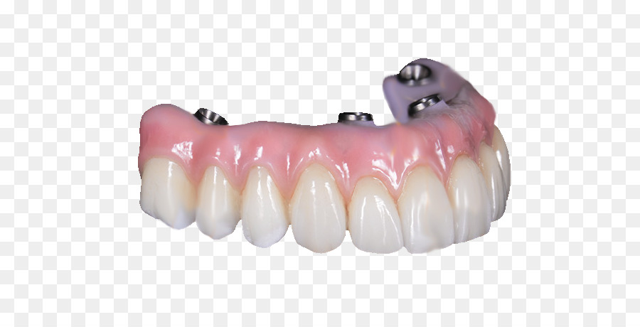 Răng tất Cả-trên-4 Răng giả Cầu Răng cấy - cầu