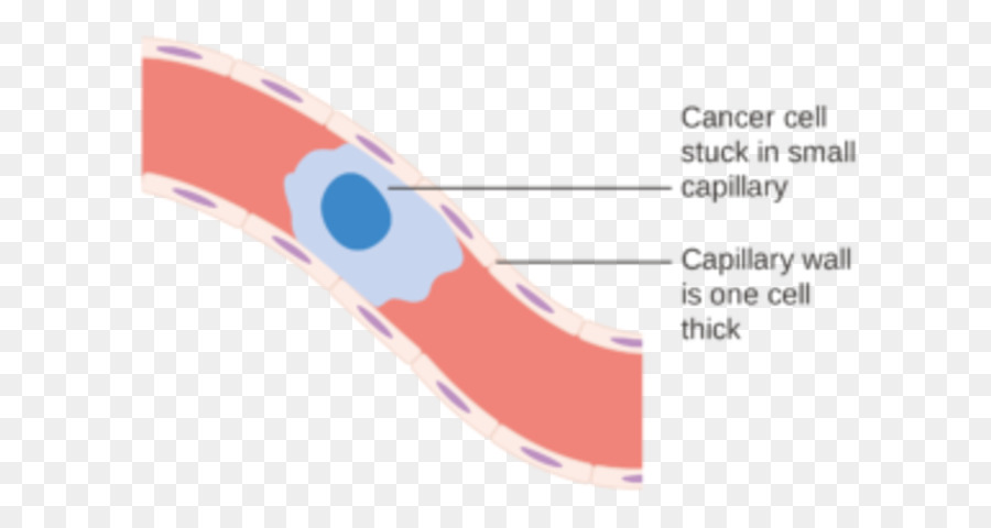 Ung thư mạch Máu tế bào Máu - máu