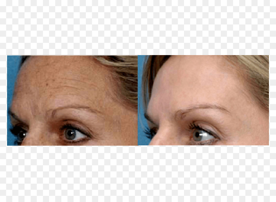 Photorejuvenation Gesichts Verjüngung Kollagen Induktions Therapie Haut - Falten