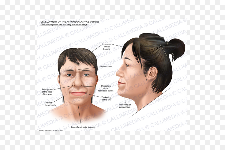 Akromegalie Gesicht Gigantismus Symptom Nase - Gesicht