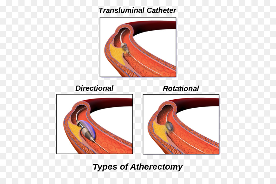 Atherectomy Peripheren Arterie Krankheit Surgery der Cleveland Clinic - Gefäß bypass