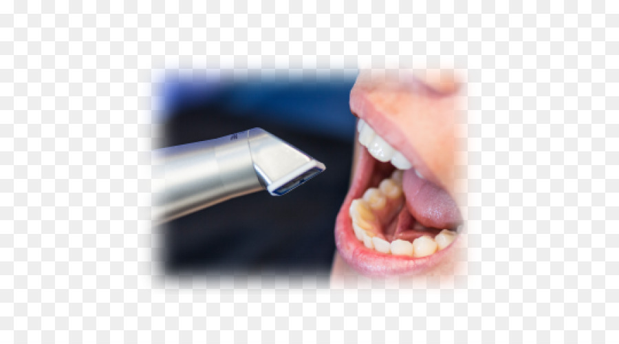 Dente Immagine scanner odontoiatria CAD/CAM Scanner - moiré