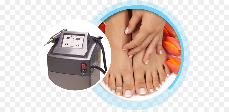 Ngón chân vòng Chân Móng tay Nấm - điều trị bằng laser