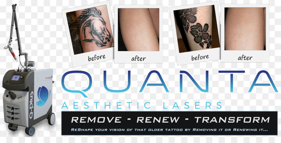 Il punto di infiammabilità del Tatuaggio Società di rimozione del Tatuaggio del Laser di Cover-up - altri