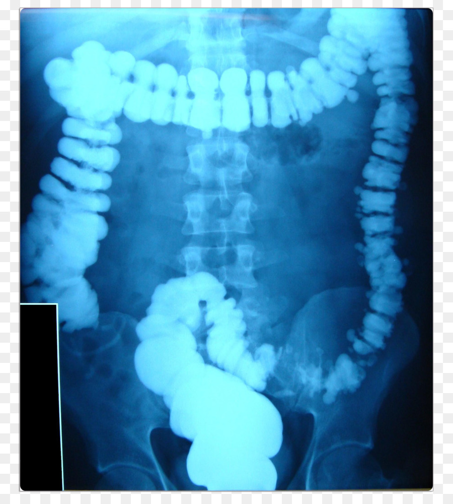 Lower Gastrointestinal Series X Ray