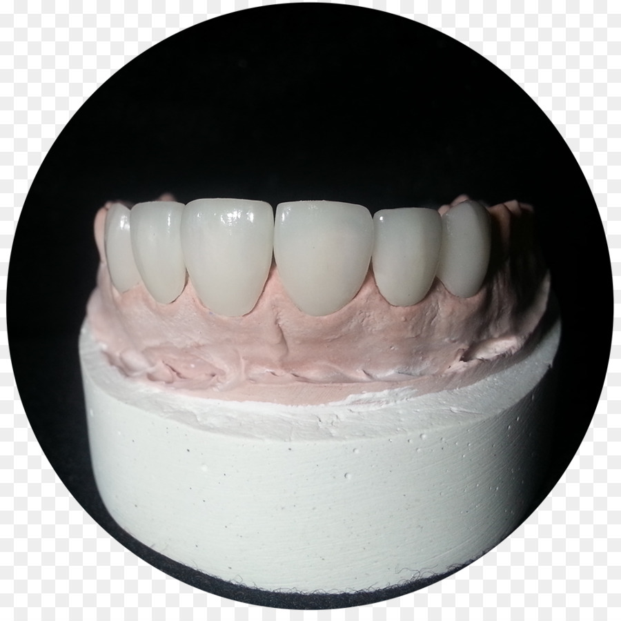 Viax Dental Panamá Glas Keramik Technologie - zahn Krone