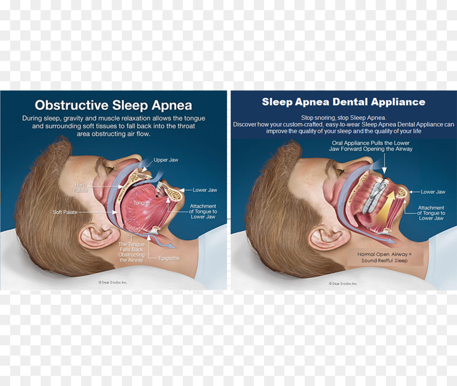 Obstruktive Schlaf-Apnoe-Continuous positive airway pressure - Schnarchen