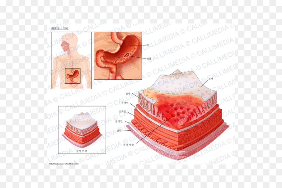 Ulcera peptica ulcera Cutanea Erosione artista sulla mucosa record membrane ulcera della Bocca - ulcera