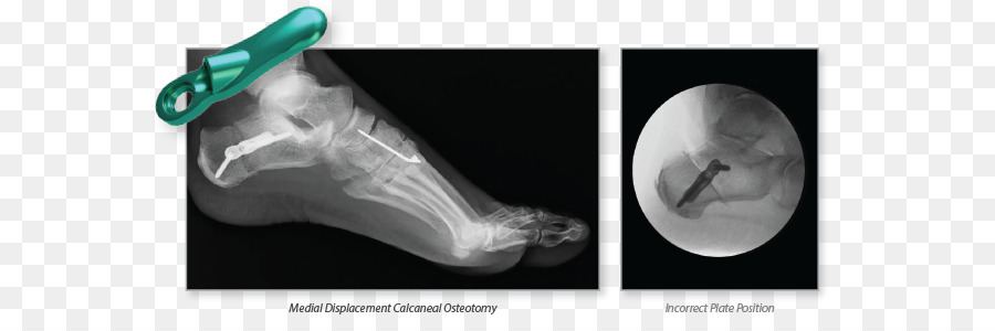Osteotomie Calcaneus Bone Joint Wright Medical Group - Fuß closeup