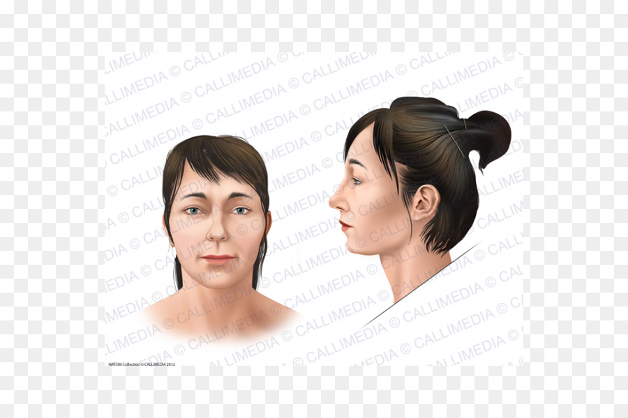 Akromegalie Gesicht Schädel Chef Symptom Gigantismus - Gesicht