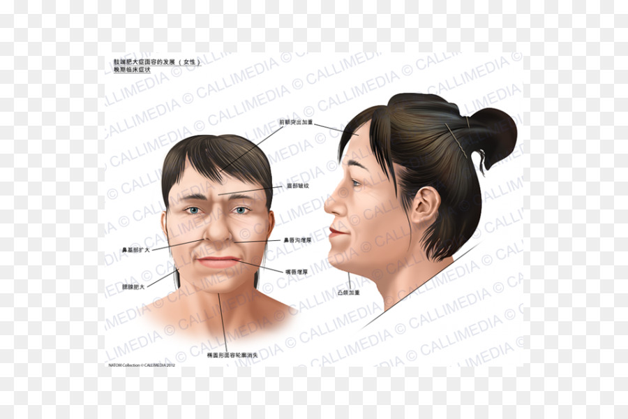 Akromegalie Gesicht Symptom Gigantischen Schädel der Chef - Gesicht