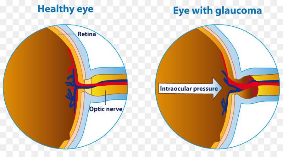 Menschliche Auge Glaukom Augenarzt den Sehnerv - Auge