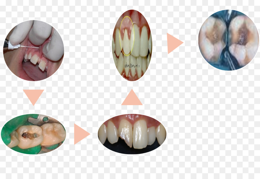 La terapia endodontica di canale di Radice di Odontoiatria Ya lo sabemos Polpa - endodonzia