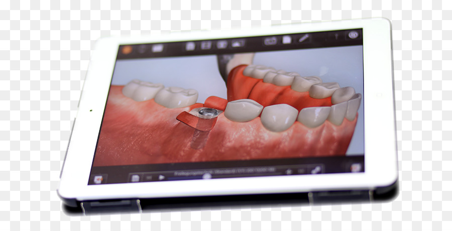 iPad 2-Netbook Zahnarzt Implantologie Zahnimplantat - Arzt mit ipad