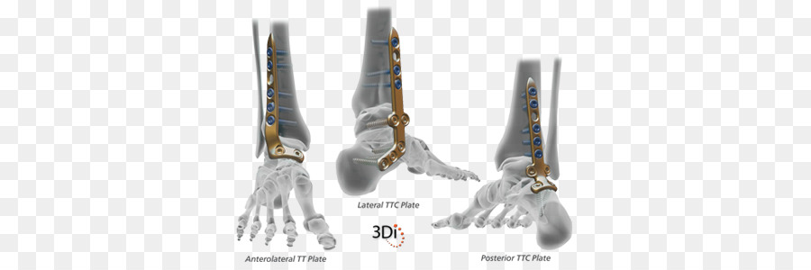 Wright Medical Dinamica di Gruppo piastra di compressione alla Caviglia Chirurgia Medicina - medico lame