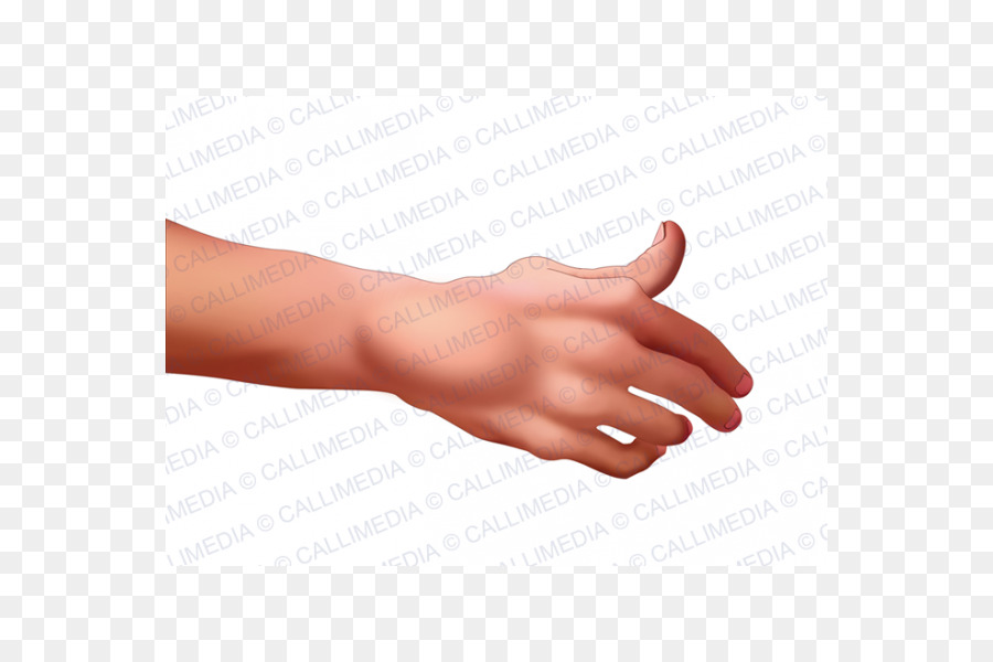 Daumen-Rheumatoide arthritis-La-artritis-Rheuma - Hand