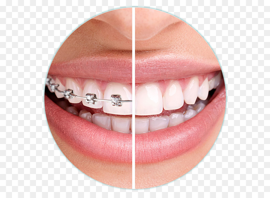 Odontoiatria ortodonzia Dentale parentesi graffe di allineatori trasparenti - salute