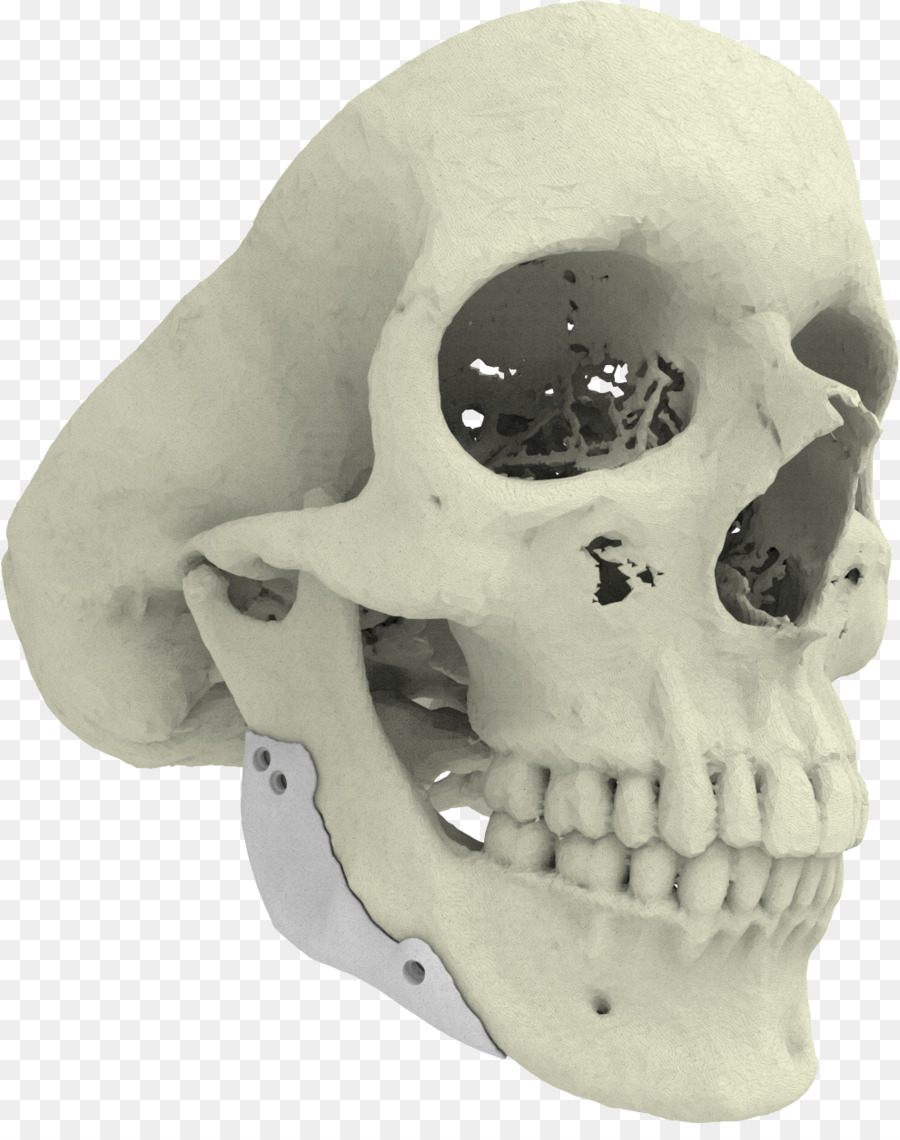 3D-Druck-Implantat-Knochen Xilloc - 3d gedruckte Unterkiefer