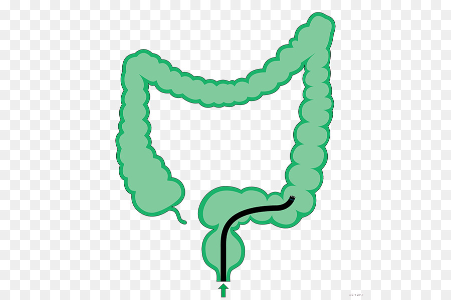La colonscopia intestino crasso colon Sigma colon Discendente - altri