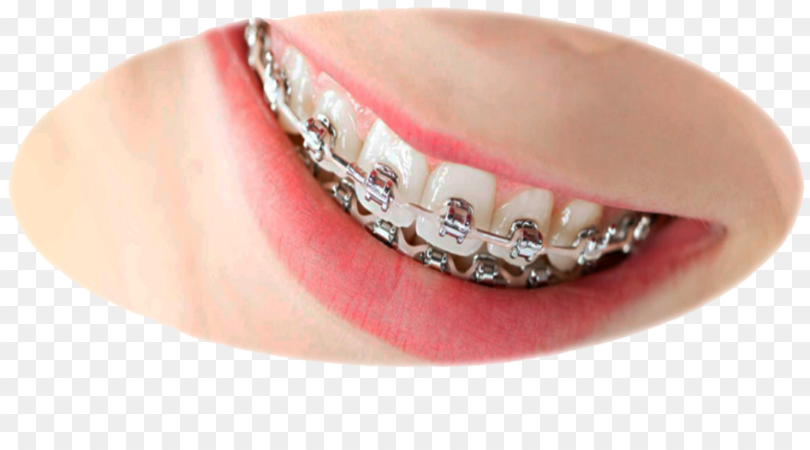 ortodonzia Dentale parentesi graffe Odontoiatria - teschio di zucchero