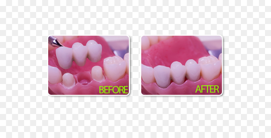 Ponte di Odontoiatria implantare Corona - ponte dentale