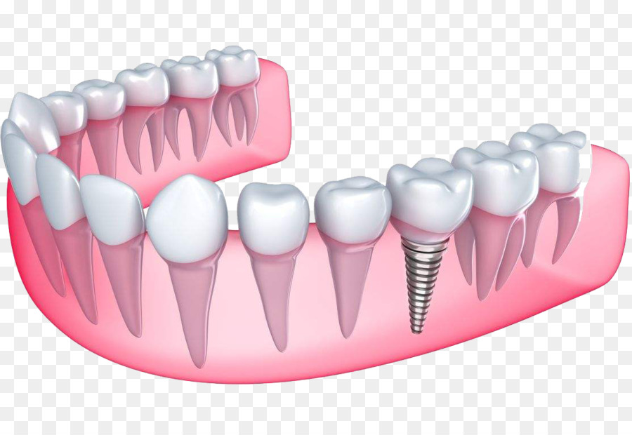 Desert View Dental Dental Implantologie und Zahnersatz - Zahnimplantat