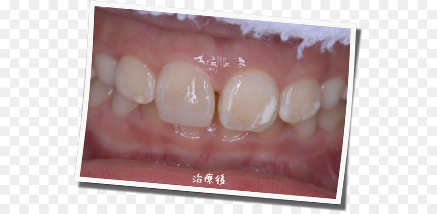 Zahn, Zahnfleisch, Zahnspangen, Zahn-Mundschutz Gebiss - Dental Postkarte