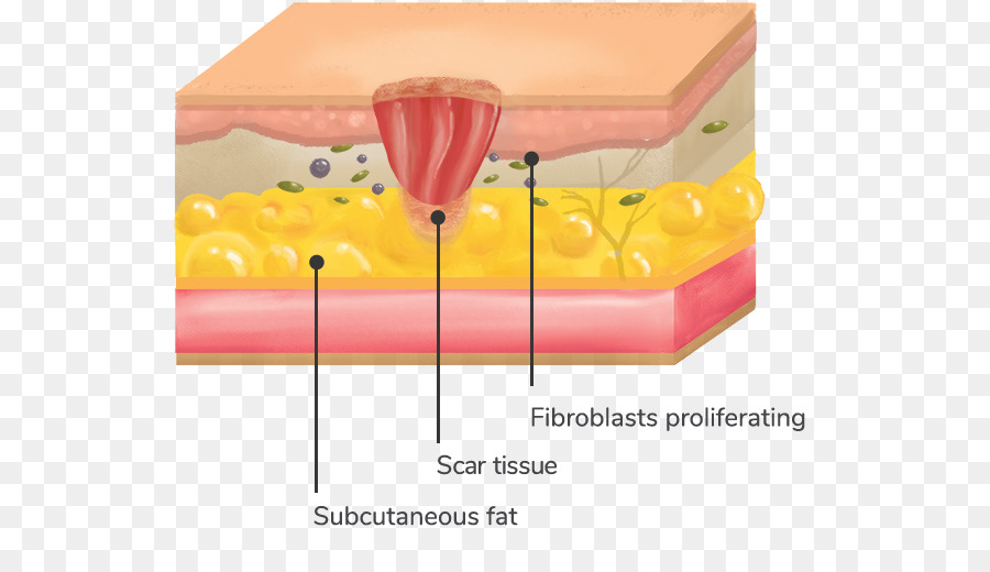 Cicatrice di tessuto di Granulazione Ferita Collagenasi di Attualità - cicatrice