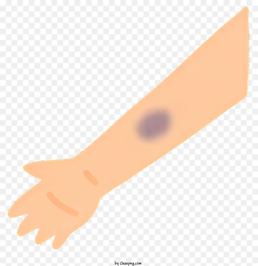 Clipart gequetschte Unterarm dunkelviolett Bluterguss Arm Schmerz Natürlicher Blutergüsse - Schwarz -Weiß -Bild von verletztem Arm